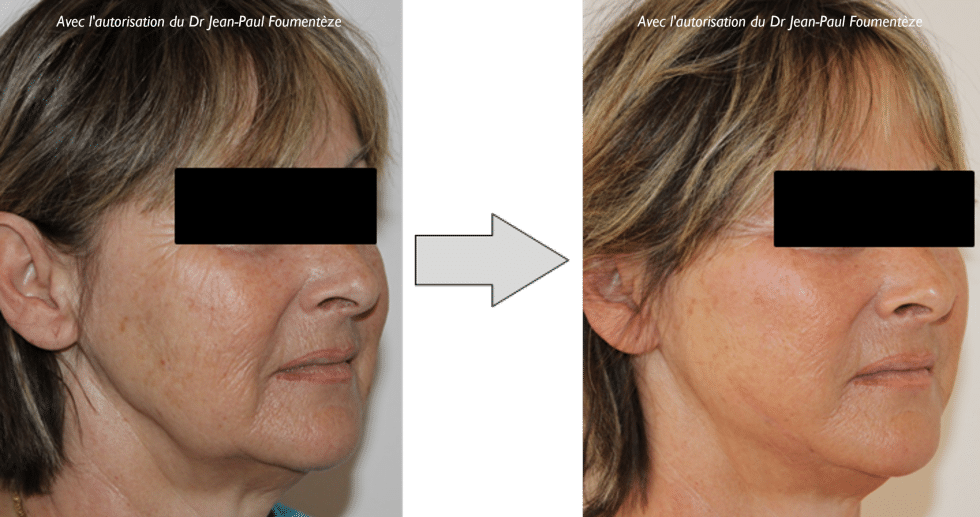 Fils Tenseurs Permanents Lifting Du Visage And Du Cou Sans Chirurgie